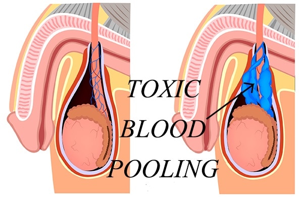 varicocele toxic blood pooling (requires treatment)