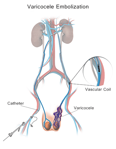 Effective Treatment Options for Varicocele: Exploring the Best